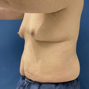 Tummy Tuck #9-before