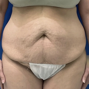 Mommy Makeover #9-before