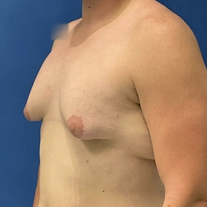 Male Breast Reduction #7-before