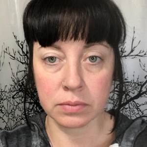 Midface/undereye-before