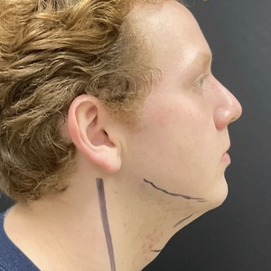 Lipo w Skin Tightening Face #6-before