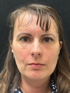 1 month post op Morpheus8 and Nanofat treatment-after