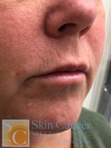 lip filler-after