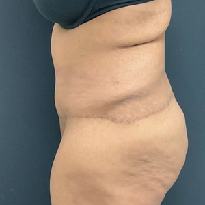 Tummy Tuck #16-after