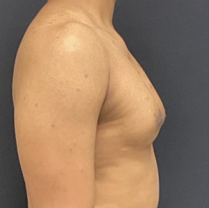 Male Breast Reduction #8-before