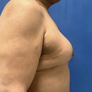 Male Breast Reduction #2-before