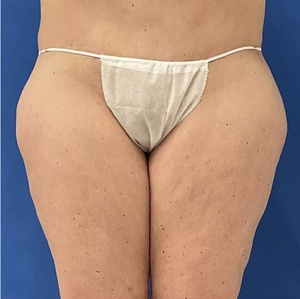 Lipo w Renuvion #1-before