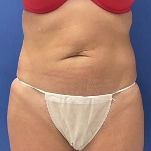 Tummy Tuck #15-before