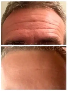 Botox-before