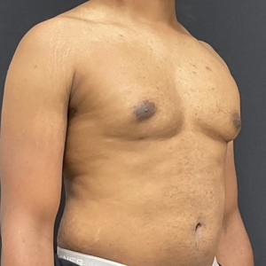 Lipo w BodyTite #9-after