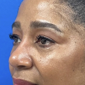 Brow & Eye Lift #1-after