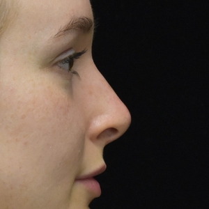 Liquid Rhinoplasty (filler)-after