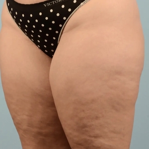 Lipo w BodyTite #7-before