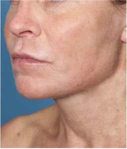Skin Texture and Laxity-after