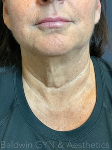 fusion tip rt topical lt infused exosomes-before