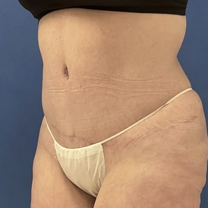 Tummy Tuck #1-after