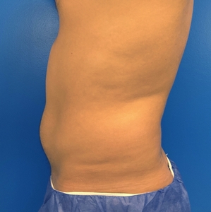 Liposuction #4-before