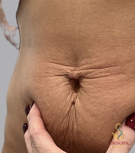 xerf one treatment-after