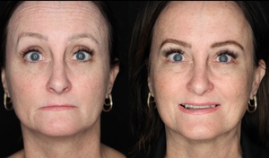 chotox - 20u gl, 10 u fh, 24u CF, 6u lips, 6u mentalis-before