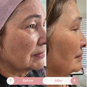 Coolpeel-before