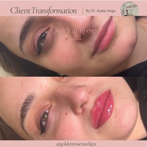 Revanesse Lip Fillers-before