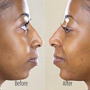 Filler SBA B/A 37-before