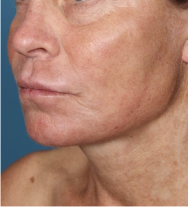 Skin Texture and Laxity-before