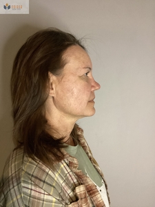 After 1 MN session K. Dorsey-after