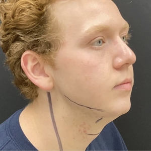 Lipo w Skin Tightening Face #6-before