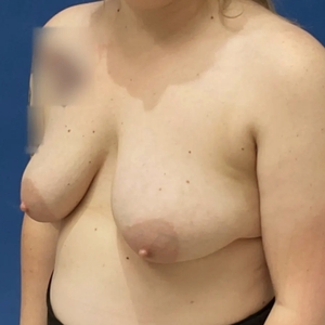 Breast Lift #1-before