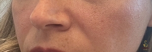 Nouvaderm Laser Treatment- Cheeks-24 hours Post Treatment-after
