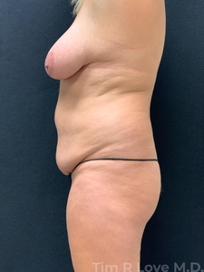 6 months post op tummy tuck and breast augmentation with a lift-before