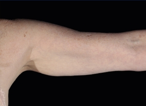 Emsculpt NEO #4-after