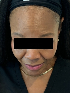 Xeomin (Neurotoxin) for Forehead Lines-after