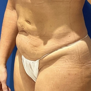 Tummy Tuck #5-before
