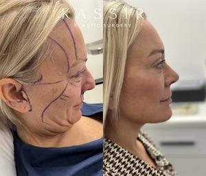 Deep Plane Face Lift NYC-after