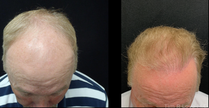 10,600 Hair Grafts-before