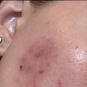 Laser Resurfacing #3-before