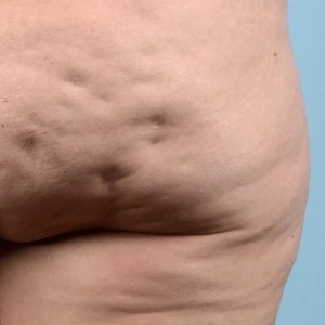 Cellulite Reduction #1-before