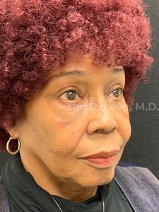 Blepharoplasty - Lower-after