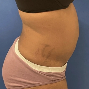 Lipo w Renuvion #10-before