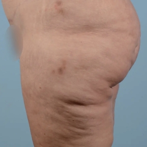 Cellulite Reduction #1-before