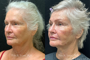 1 year post op short scar face lift and upper lip lift, MyEllevate, Facetite, Morpheus8 x2, Sculptra-before