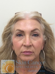 Nova threads and Filler-after