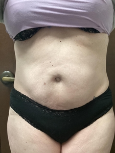 Edge 6 Treatments-after