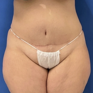 Tummy Tuck #9 (front)-after