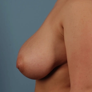 Breast Reductoin #4 (left)-before