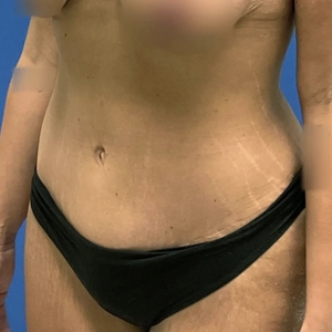 Tummy Tuck #3-after