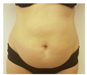 Body Contouring-before