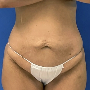 Tummy Tuck #3-before